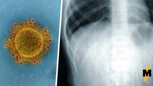 Реддитор показал рентген лёгких, поражённых COVID-19. Это заставило вспомнить пользователей Сети свои истории